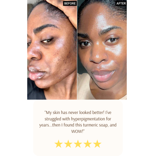Turmeric & Kojic Acid Brightening Soap